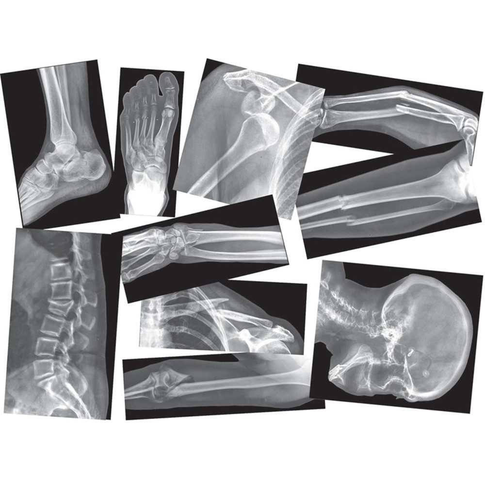 R-5914 - Broken Bones X-Rays in Human Anatomy